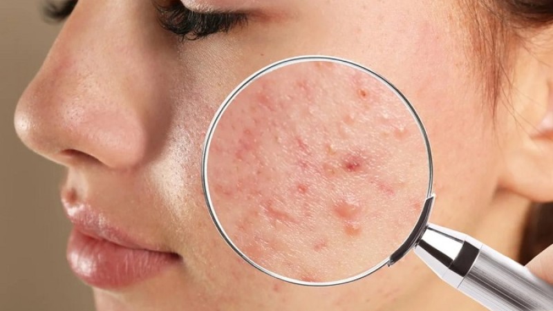 ব্রণ দূর করতে যে ৩ কাজ করবেন