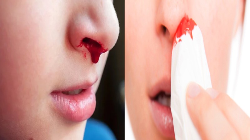 হঠাৎ নাক দিয়ে রক্ত পড়ার কারণ ও করণীয়