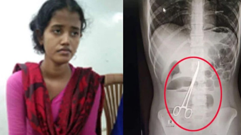 দেড় বছর পর পেট থেকে বের করা হলো সেই কাঁচি