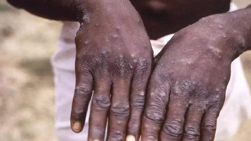 শুরু আফ্রিকায়,  মাঙ্কিপক্স ছড়িয়েছে বিশ্বের ৭৫ দেশে