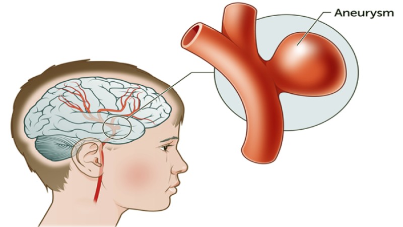 ব্রেন টিউমারের চিকিৎসা-লক্ষণ