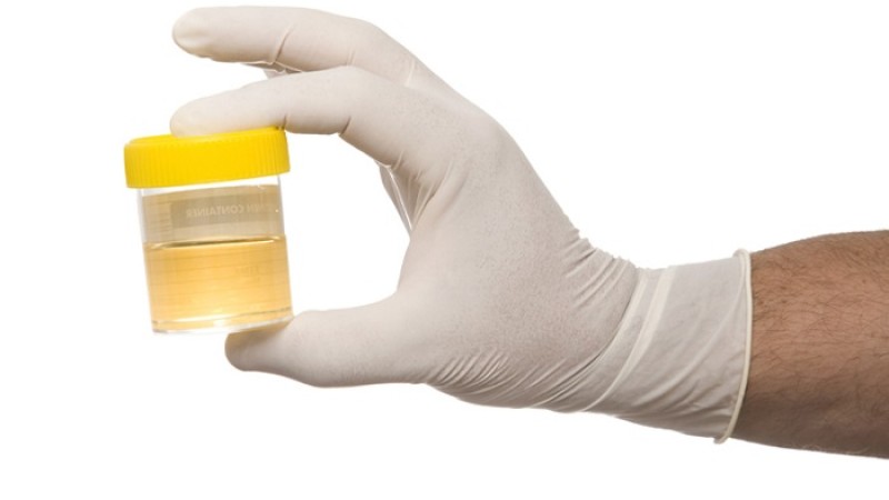 প্রস্রাবে অতিরিক্ত দুর্গন্ধ হতে পারে কঠিন রোগের লক্ষণ