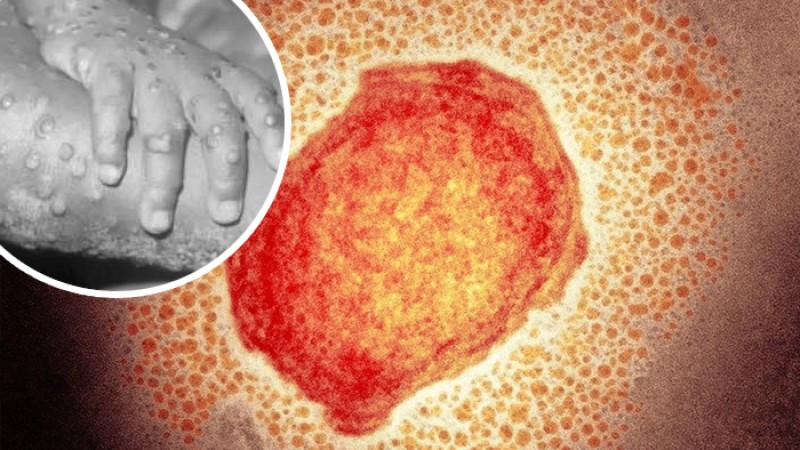 বিশ্বে মাঙ্কিপক্স আক্রান্ত ২১৯