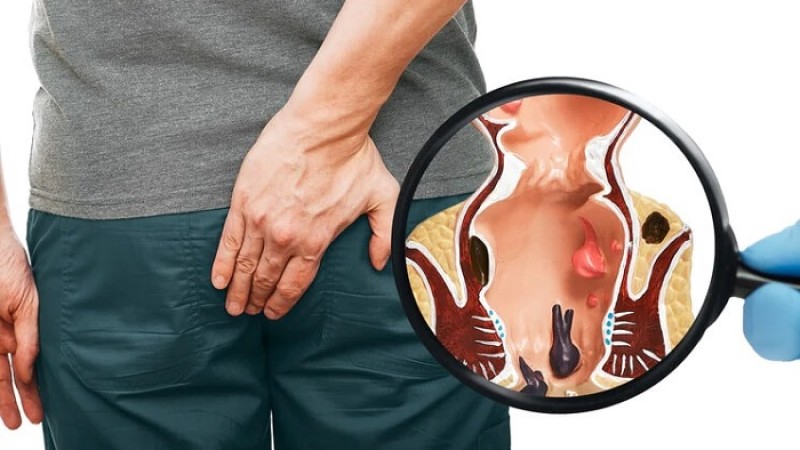 পাইলসের লক্ষণ জেনে নিন