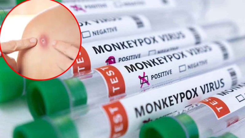 দেশে মাঙ্কিপক্স আক্রান্ত রোগী নেই