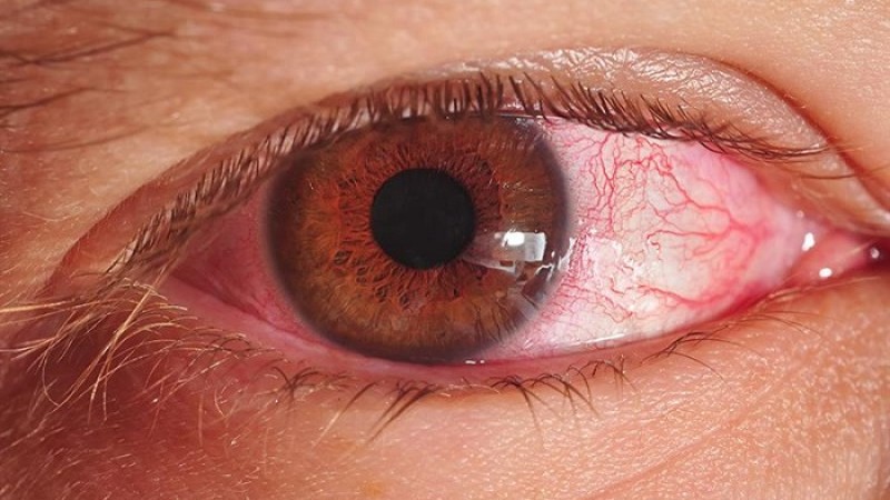 হাই প্রেশার আছে কি না বুঝে নিন চোখ দেখেই