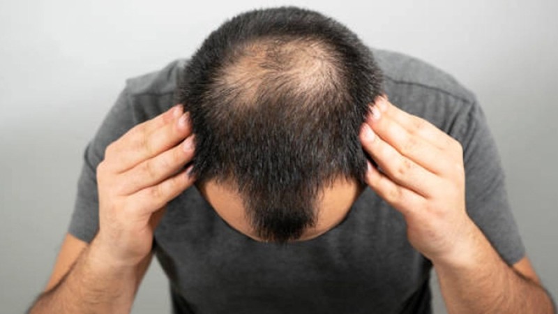 পুরুষদের ‘টেকো’ বলা যৌন হয়রানি