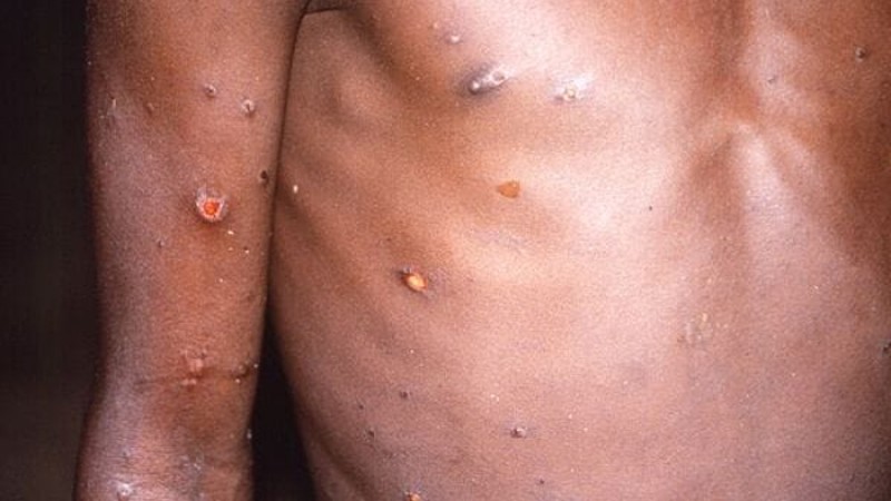 মাঙ্কিপক্সে বিচ্ছিন্নবাসের ঘোষণা বেলজিয়ামে