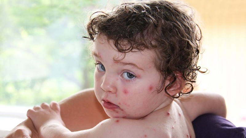 চিকেন পক্স দ্রুত সারাতে যা করবেন ও যা খাবেন